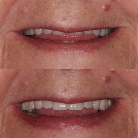 Before And After Dentures Kevin Manners Denture Clinics