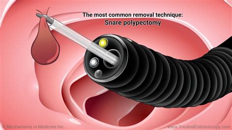 Colonoscopy