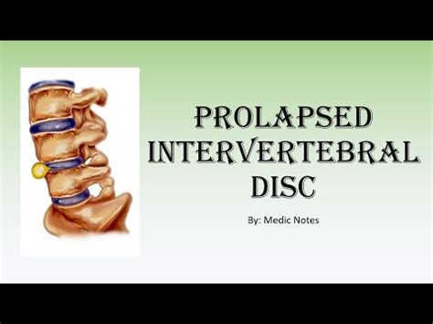 Ortho Prolapsed Intervertebral Disc Types Of Herniation S S