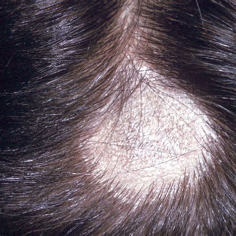 Patchy Hair Loss - Dr. Niketa Sonavane