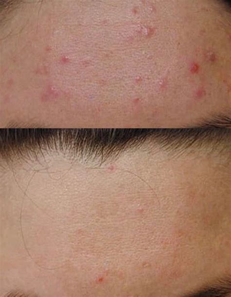 Efudix Treatment For Sun Spots And Pre Cancerous Lesions Cutis Dermatology