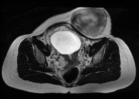 Magnetic Resonance In A Pregnant Woman Revealing Abdominal Wall Desmoid Download Scientific