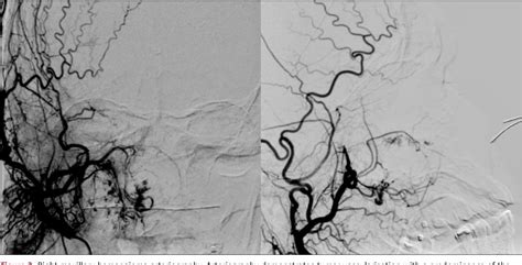 Figure From A Rare Case Of Giant Cavernous Hemangioma Of The