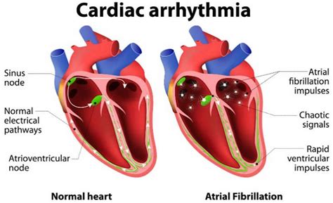 Heart Dysrhythmia Causes Signs Symptoms Diagnosis Treatment