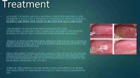 Oral Hairy Leukoplakia 2 Ppt