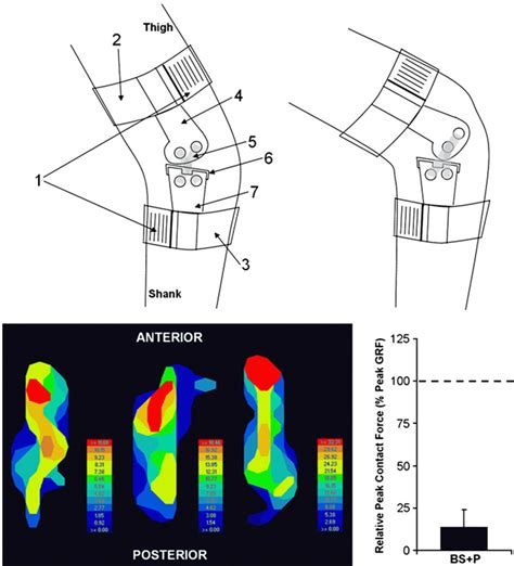 Figure From Effect Of An Anterior Sloped Brace Joint On Anterior