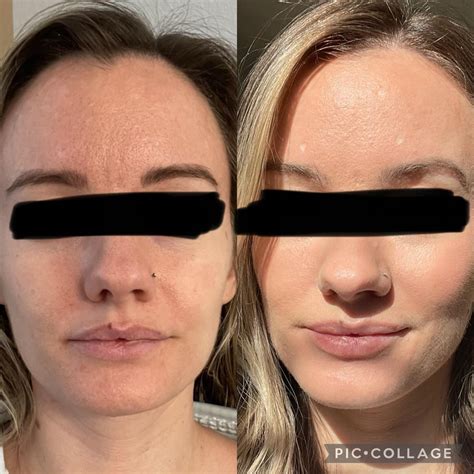 Three Months On Tret And Loving My Results So Far R Tretinoin