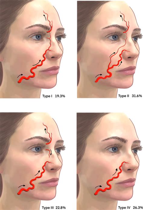 An Illustrated Anatomical Approach To Reducing Vascular Risk During