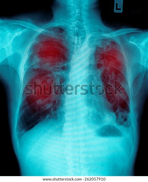 Film Chest Xray Show Alveolar Infiltrate Foto Stok Shutterstock