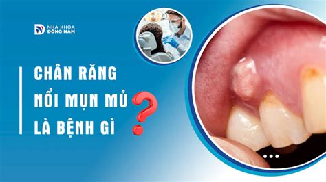 Mụn Mủ Ở Chân Răng Nguyên Nhân và Cách Điều Trị Hiệu Quả