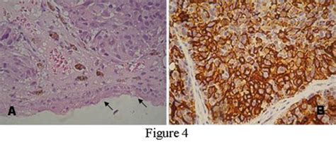 A Biopsy Section Showing Nests Of Tumour Cells With Brownish Melanin