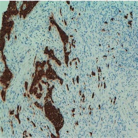 Metaplastic Carcinoma Stain For Cam 5 2 20× The Lesion Described Download Scientific