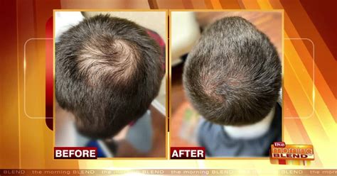 Proven And Permanent Hair Restoration Treatments