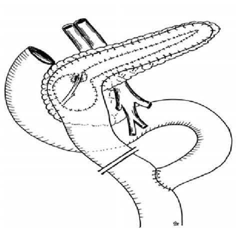 Duodenum Preserving Pancreatic Head Resection By Frey Rectosigmoid Download Scientific Diagram