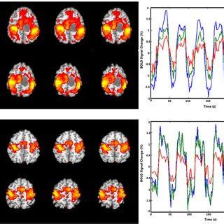 Example Of Bold Functional Magnetic Resonance Imaging Activation Maps