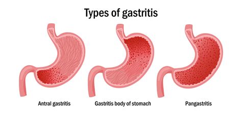 Three types of gastritis illustration 21601078 Vector Art at Vecteezy