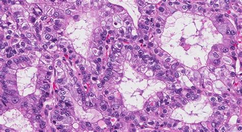 Adenocarcinoma Of The Lung Atlas Of Pathology