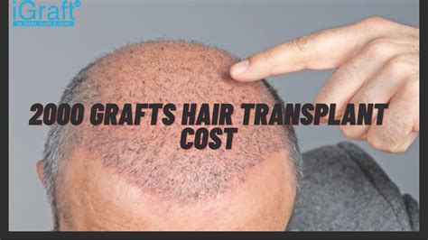 2000 grafts hair transplant cost