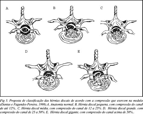 Scielo Brazil H Rnia De Disco Cervical Gigante Relato De Caso H Rnia