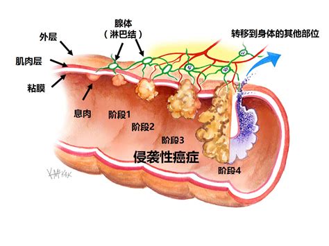 结直肠癌症 悉尼大肠外科医生