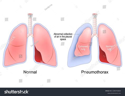 Pneumothorax Accumulation Of Air Between The Royalty Free Stock