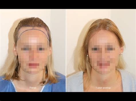 Haartransplantation Frauen Resultat Vorher Nachher Mit FUE 2423 Grafts