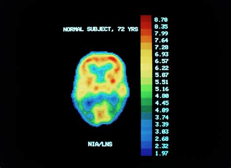 Pet Scan Of Brain Of Normal Subject Photograph by Science Photo Library ...