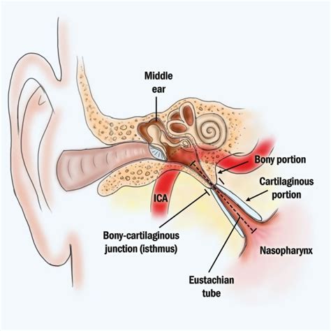 Ear Infection Diagram - exatin.info