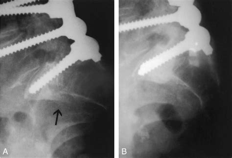 Figure 1 From Early Fracture Of The Sacrum Or Pelvis An Unusual Complication After Multilevel