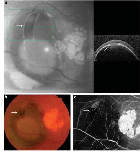 Figure 1 From Retinal Pigment Epithelial Tear Resembling Retinal Tear