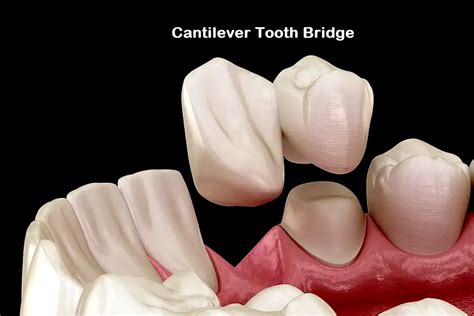 Cantilever Dental Bridge Everything You Should Know