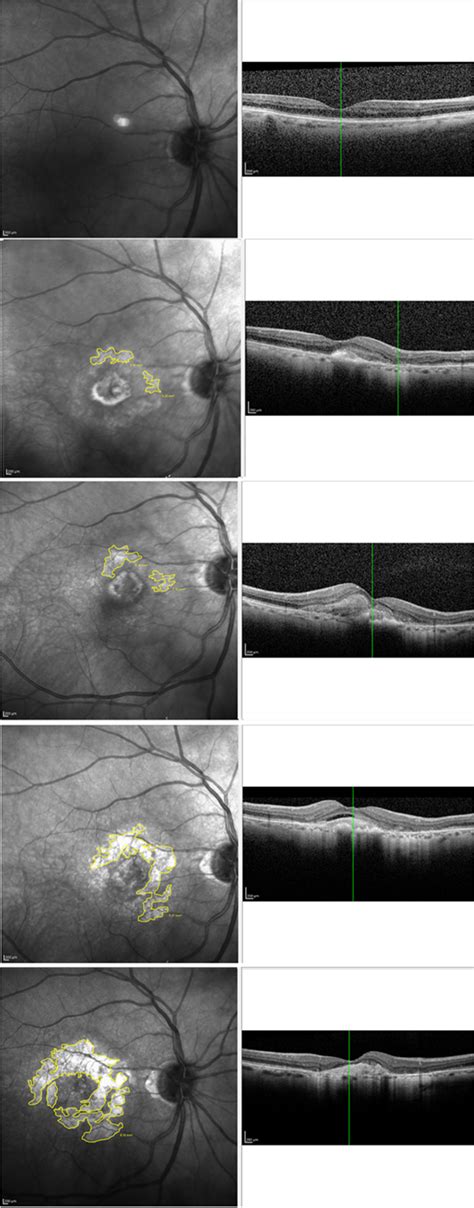 Macular atrophy progression in a patient with neovascular age-related... | Download Scientific ...