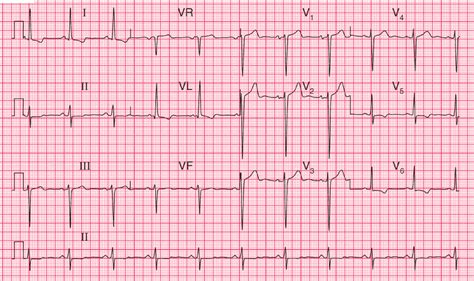 ECG Case 106: Left Atrial and Left Ventricular Hypertrophy (LVH ...