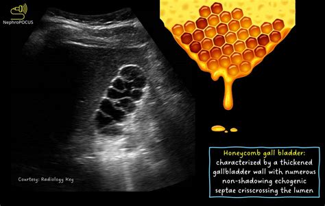 The Pocus Kingdom Nephropocus