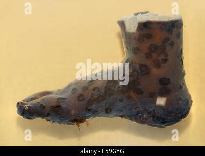 BLISTERS Stock Photo: 52487344 - Alamy