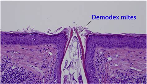 Demodex Mites Clinics In Dermatology