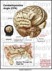 Cerebellopontine Angle (CPA) Medical Illustration Medivisuals