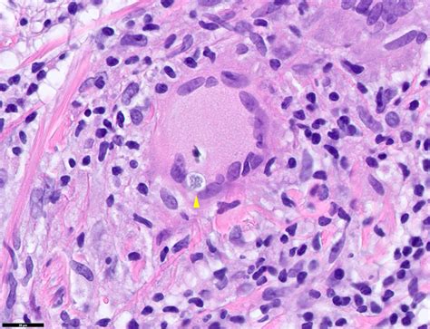 Pathology Outlines Sarcoidosis