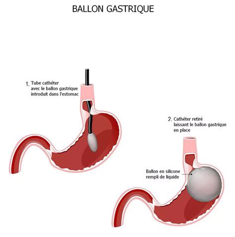 Ballon gastrique Turquie tarif opération obésité Turquie Aram Clinic