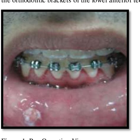 Figure 1 From Uncommon Pyogenic Granuloma In Lower Lip Of Orthodontic