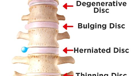 Compressed Disc Lower Back Compre Choices