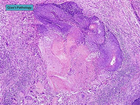 Qiao S Pathology Pilomatrixoma A Photo On Flickriver