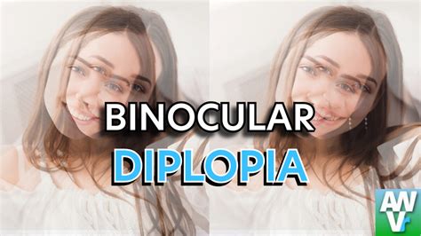binocular diplopia double vision   eyes  involved equal eyes