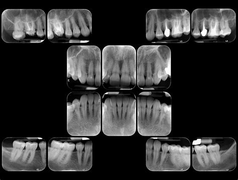 Radiografias Periapicais De Boca Completa Ou Boca Toda Odonto I