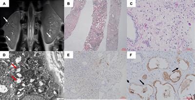 Frontiers ADTKD UMOD In A Girl With A De Novo Mutation A Case Report