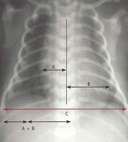 Chest Xray Flashcards Quizlet