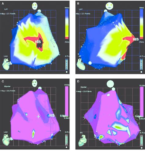 Three Dimensional Electroanatomical Maps Of The Patient S Right Atrium