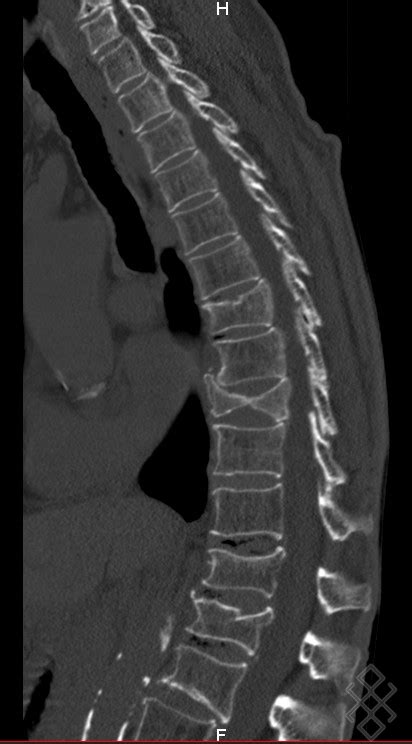 Scanner du Rachis dorsal Définition Déroulement Prise de rdv en ligne