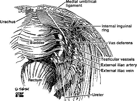 Figure 1 From Laparoscopic Pelvic And Para Aortic Retroperitoneal