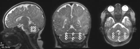 Altered Cerebellar Biochemical Profiles In Infants Born Prematurely